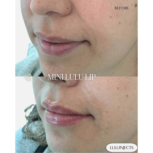 Lip filler injection before and after