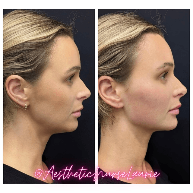 Chin, jawline, and cheek filler before and after