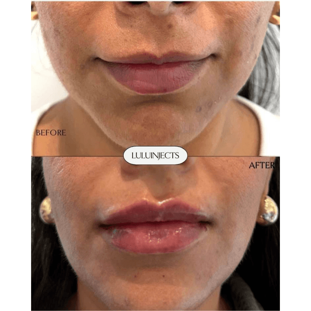 Lip Filler That Looks Like You, Just Plumped! The goal? Soft, hydrated lips with natural shape and definition. Think less “overdone,” more “you woke up like this.