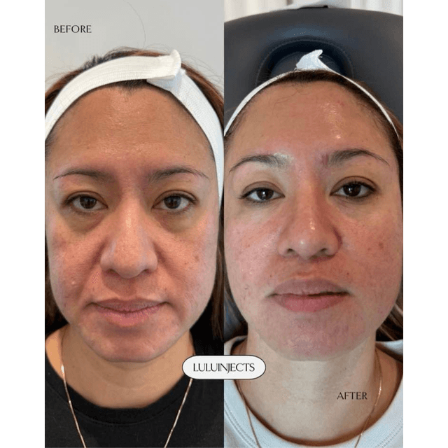 Before and after lips, cheeks, chin, jawline, and a touch of tox