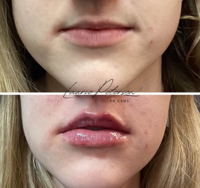 Laurie Peterson lip filler before after botox