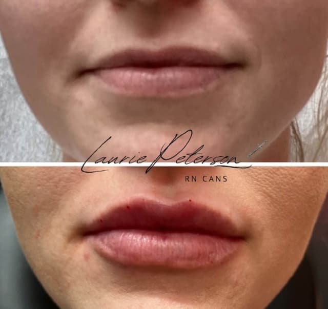 Laurie Peterson natural looking lip filler before and after