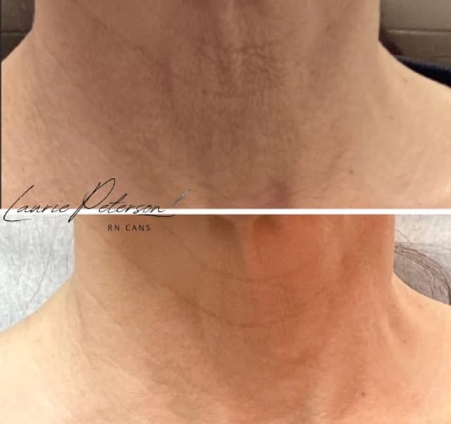 Laurie Peterson neck botox before and after results