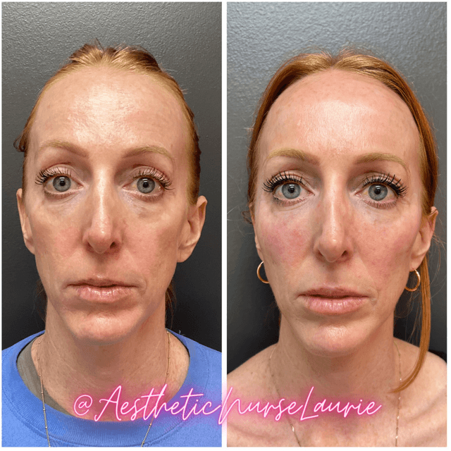 Laurie Peterson lip botox before and after